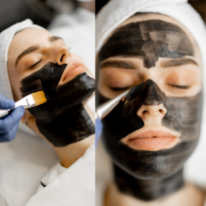رفع لک صورت با کربوکسی تراپی
