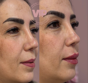 تزریق فیلر لب در کرج