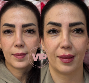 تزریق فیلر لب در چیتگر