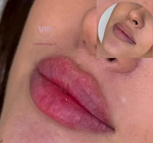فیلر لب