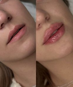 چهره های نیازمند فیلر لب