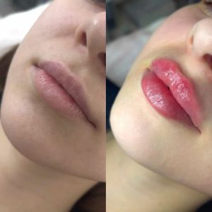 فیلر لب برای لب های نازک