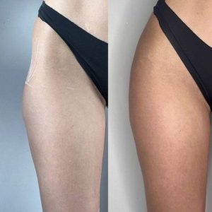 مراقبت بعد از فیلر بادی هیپ دیپ