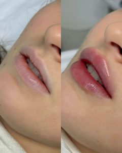 فیلر لب برای چه کسانی مناسب است؟