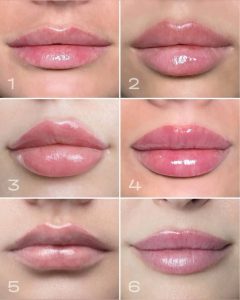 تزریق فیلر لب چقدر طول می کشد؟