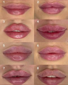 تزریق فیلر لب در پریودی