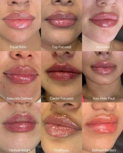 تزریق فیلر لب باریک