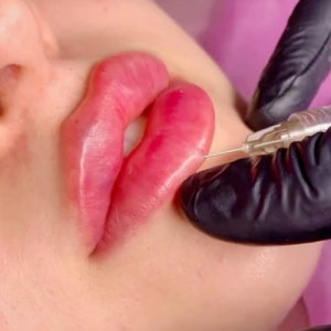 انواع مدل تزریق فیلر لب