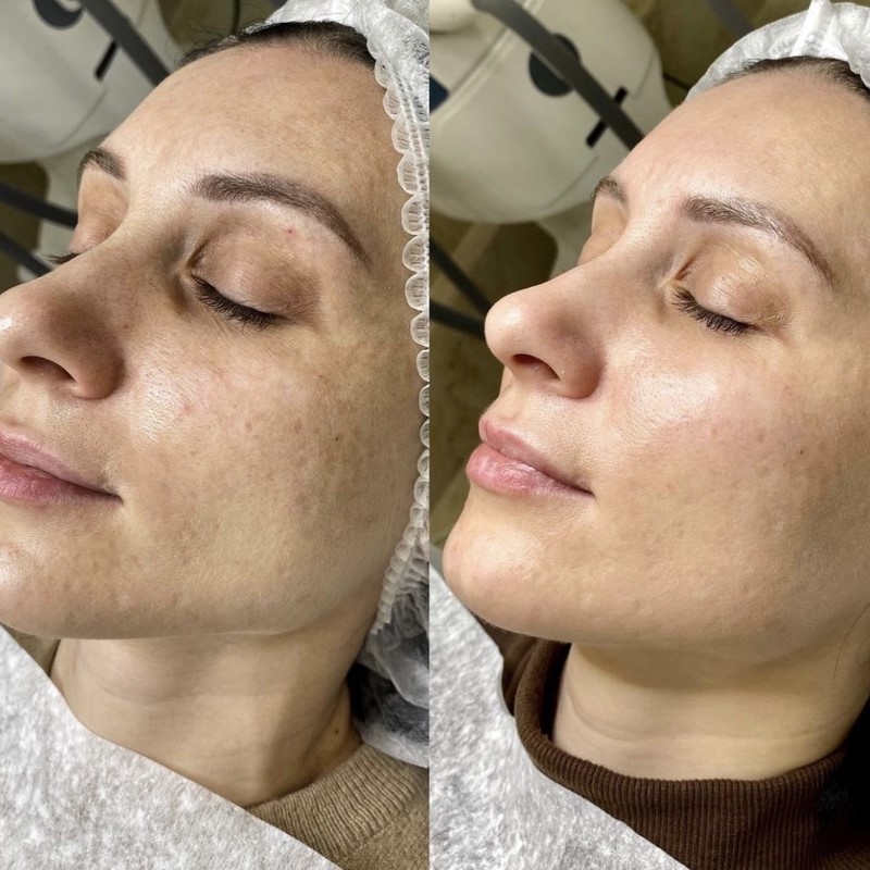 Carbon-Peel-Before-After-01