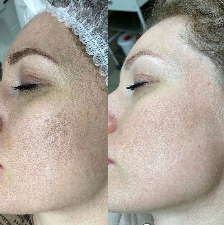 Carbon-laser-Peel-ba2