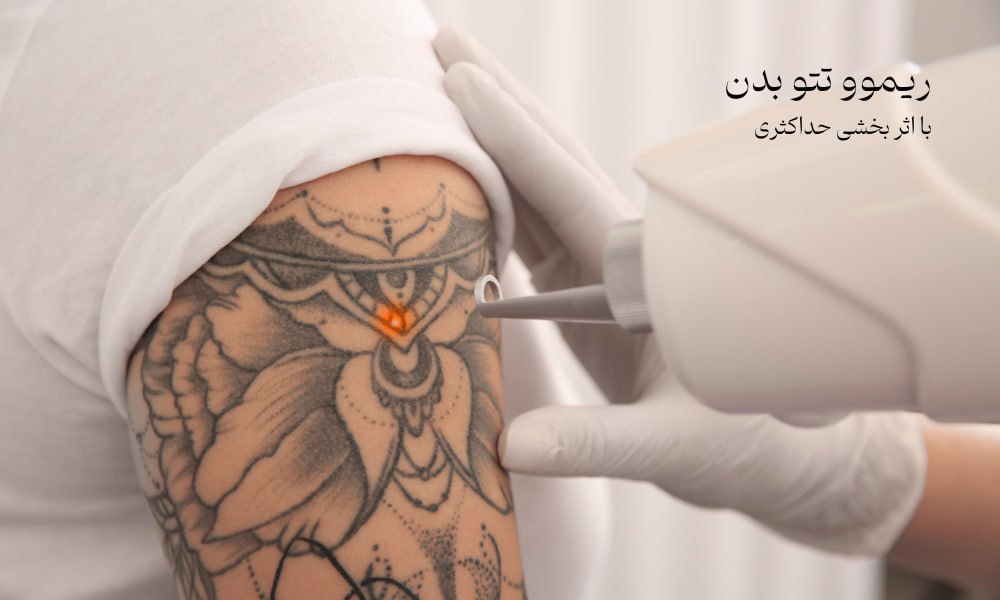 ریموو تتو با دستگاه در چیتگر