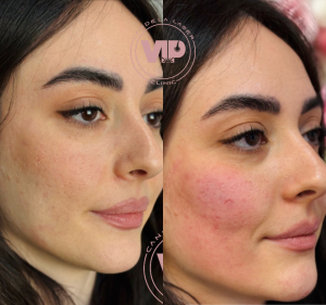 تزریق فیلر گونه و چانه در چیتگر