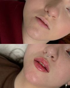 عکس تزریق ژل لب طبیعی