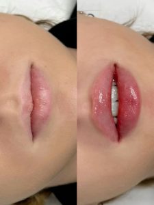 فیلر لب برای صورت لاغر