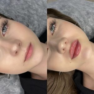 فیلر لب برای لبهای کوچک