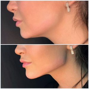 چهره های نیازمند فیلر چانه در تهران