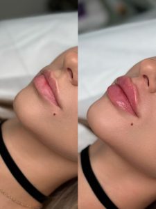 فیلر لب هیالورونیک چیست