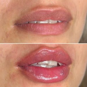 ژل لب هیالورونیک اسید