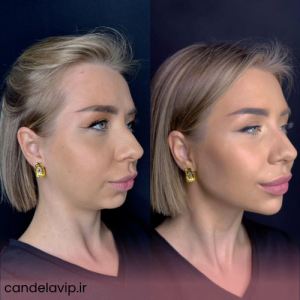 تغییر چهره با تزریق ژل